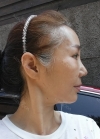 eye, nose, face lifting, fat grafting — Korea cost, reviews & before-after | MISOODA
