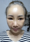 eye, nose, face lifting, fat grafting — Korea cost, reviews & before-after | MISOODA