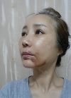eye, nose, face lifting, fat grafting — Korea cost, reviews & before-after | MISOODA