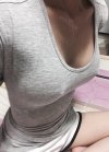 Br (m) Icom _ teardrop implants on both sides 315cc 162 / 56kg — Korea cost, reviews & before-after | MISOODA