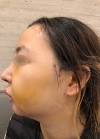 Eye, Nose, Facial contouring at View — Korea cost, reviews & before-after | MISOODA