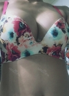 Br (m) Icom _ teardrop implants on both sides 315cc 162 / 56kg — Korea cost, reviews & before-after | MISOODA