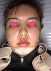 facial contouring, double eyelid revision and forehead fat graft — Korea cost, reviews & before-after | MISOODA