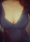Br (m) Icom _ teardrop implants on both sides 315cc 162 / 56kg — Korea cost, reviews & before-after | MISOODA