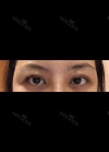 Eyes and Accuift surgery — Korea cost, reviews & before-after | MISOODA