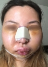 Eye, Nose, Facial contouring at View — Korea cost, reviews & before-after | MISOODA