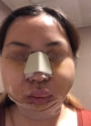 Eye, Nose, Facial contouring at View — Korea cost, reviews & before-after | MISOODA