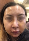 Eye, Nose, Facial contouring at View — Korea cost, reviews & before-after | MISOODA