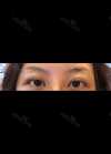 Eyes and Accuift surgery — Korea cost, reviews & before-after | MISOODA