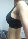 Br (m) Icom _ teardrop implants on both sides 315cc 162 / 56kg — Korea cost, reviews & before-after | MISOODA
