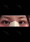 Eyes and Accuift surgery — Korea cost, reviews & before-after | MISOODA