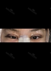 Eyes and Accuift surgery — Korea cost, reviews & before-after | MISOODA