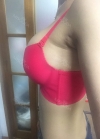 Br (m) Icom _ teardrop implants on both sides 315cc 162 / 56kg — Korea cost, reviews & before-after | MISOODA