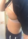 Br (m) Icom _ teardrop implants on both sides 315cc 162 / 56kg — Korea cost, reviews & before-after | MISOODA