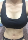 Br (m) Icom _ teardrop implants on both sides 315cc 162 / 56kg — Korea cost, reviews & before-after | MISOODA