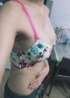 Br (m) Icom _ teardrop implants on both sides 315cc 162 / 56kg — Korea cost, reviews & before-after | MISOODA