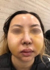 Eye, Nose, Facial contouring at View — Korea cost, reviews & before-after | MISOODA
