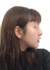 facial contouring, double eyelid revision and forehead fat graft — Korea cost, reviews & before-after | MISOODA