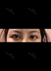 Eyes and Accuift surgery — Korea cost, reviews & before-after | MISOODA