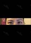 Eyes and Accuift surgery — Korea cost, reviews & before-after | MISOODA