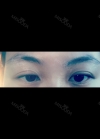 Eyes and Accuift surgery — Korea cost, reviews & before-after | MISOODA