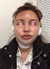 facial contouring, double eyelid revision and forehead fat graft — Korea cost, reviews & before-after | MISOODA