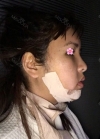 facial contouring, double eyelid revision and forehead fat graft — Korea cost, reviews & before-after | MISOODA