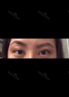 Eyes and Accuift surgery — Korea cost, reviews & before-after | MISOODA