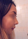 Eye, Nose, Facial contouring at View — Korea cost, reviews & before-after | MISOODA