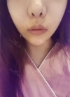 Philtrum Reduction, Lovely Smile Balanced, Cupid’s bow lip Surgery — Korea cost, reviews & before-after | MISOODA