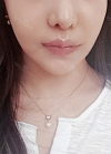 Philtrum Reduction, Lovely Smile Balanced, Cupid’s bow lip Surgery — Korea cost, reviews & before-after | MISOODA