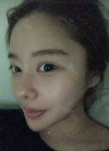 Double eyelid revision, Nose revision, Facial Liposuction, Face Fat Grafting — Korea cost, reviews & before-after | MISOODA