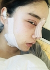 Double eyelid revision, Nose revision, Facial Liposuction, Face Fat Grafting — Korea cost, reviews & before-after | MISOODA