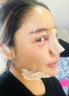 Double eyelid revision, Nose revision, Facial Liposuction, Face Fat Grafting — Korea cost, reviews & before-after | MISOODA