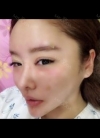 Double eyelid revision, Nose revision, Facial Liposuction, Face Fat Grafting — Korea cost, reviews & before-after | MISOODA