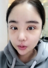Double eyelid revision, Nose revision, Facial Liposuction, Face Fat Grafting — Korea cost, reviews & before-after | MISOODA