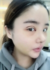 Double eyelid revision, Nose revision, Facial Liposuction, Face Fat Grafting — Korea cost, reviews & before-after | MISOODA