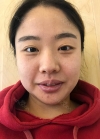 Double eyelid revision, Nose revision, Facial Liposuction, Face Fat Grafting — Korea cost, reviews & before-after | MISOODA