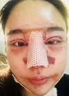 Double eyelid revision, Nose revision, Facial Liposuction, Face Fat Grafting — Korea cost, reviews & before-after | MISOODA