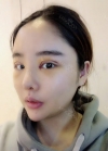 Double eyelid revision, Nose revision, Facial Liposuction, Face Fat Grafting — Korea cost, reviews & before-after | MISOODA