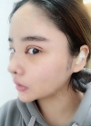 Double eyelid revision, Nose revision, Facial Liposuction, Face Fat Grafting — Korea cost, reviews & before-after | MISOODA