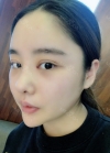 Double eyelid revision, Nose revision, Facial Liposuction, Face Fat Grafting — Korea cost, reviews & before-after | MISOODA