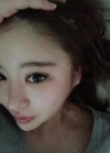 Double eyelid revision, Nose revision, Facial Liposuction, Face Fat Grafting — Korea cost, reviews & before-after | MISOODA