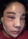Double eyelid revision, Nose revision, Facial Liposuction, Face Fat Grafting — Korea cost, reviews & before-after | MISOODA