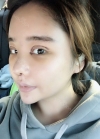 Double eyelid revision, Nose revision, Facial Liposuction, Face Fat Grafting — Korea cost, reviews & before-after | MISOODA
