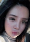 No more bulbous noses! — Korea cost, reviews & before-after | MISOODA