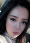 Beautiful eyelids with Hyundai Aesthetics — Korea cost, reviews & before-after | MISOODA