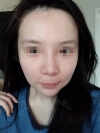 No more bulbous noses! — Korea cost, reviews & before-after | MISOODA
