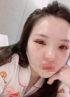 Beautiful eyelids with Hyundai Aesthetics — Korea cost, reviews & before-after | MISOODA