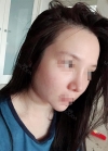 No more bulbous noses! — Korea cost, reviews & before-after | MISOODA